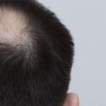 Why Are You Losing Hair?