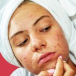 Everything You Need to Know About Dermatillomania