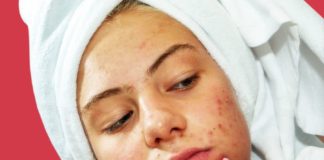 Everything You Need to Know About Dermatillomania