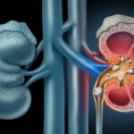 Protect Your Kidneys from Stones by Eating a Healthy Diet