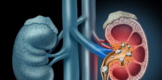 Protect Your Kidneys from Stones by Eating a Healthy Diet